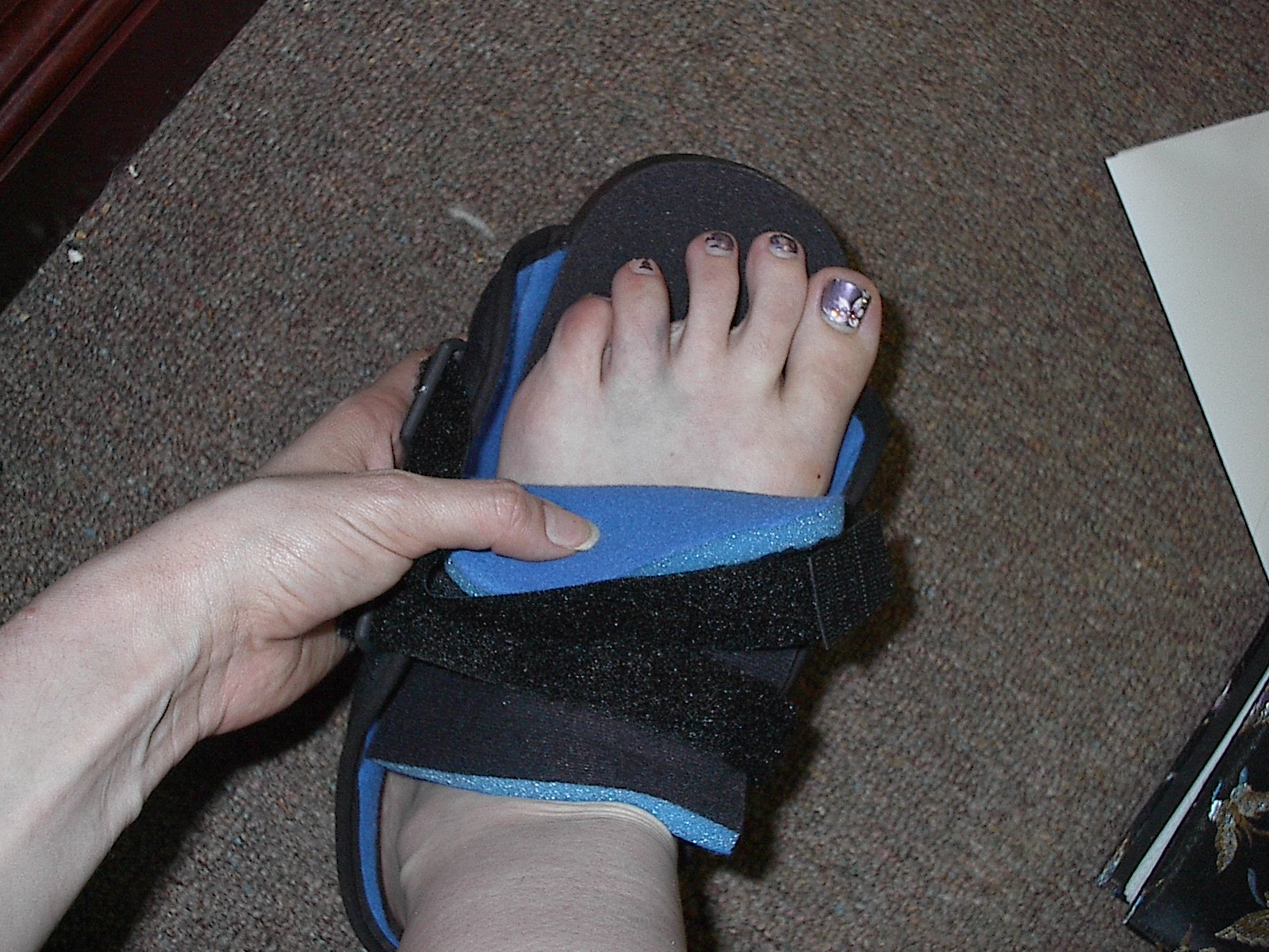 Broken Toe in Soft Cast with Pedicure